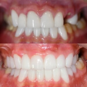 歯を抜歯した方、歯のセラミックブリッジがお得に受けられるモニター インプラントが怖い方　入れ歯はまだ早い方　綺麗に噛める歯を作りたい方におススメ