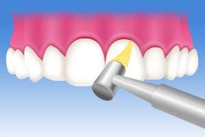 歯間や歯周ポケットの清掃 PMTC