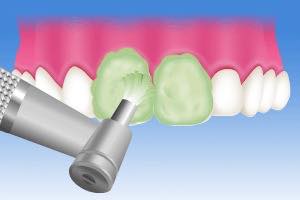 歯面の清掃 PMTC