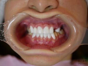 歯のブリッジ 南青山矯正歯科 審美歯科