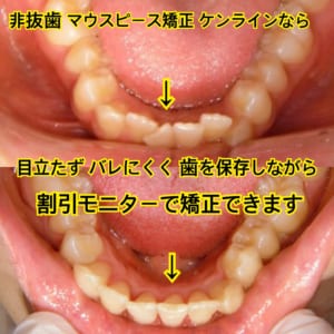 1トレー3万円〜!2週間の治療期間からはじめるバレないマウスピース矯正(ケンライン)