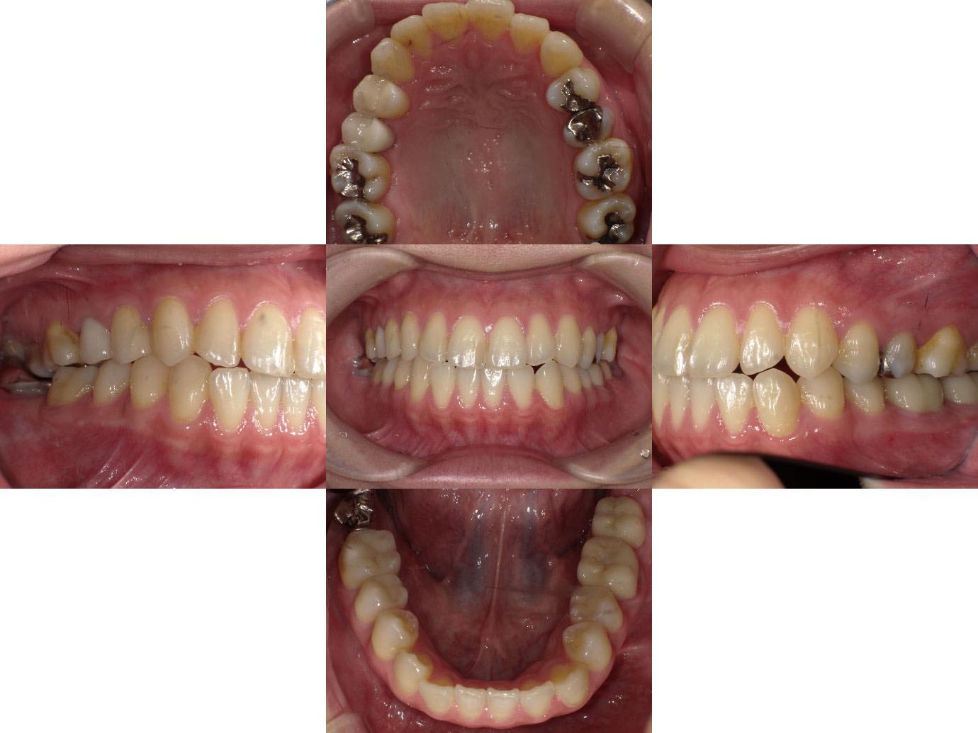 治療後 虫歯治療後に入れた銀歯をセラミッククラウンに交換した症例