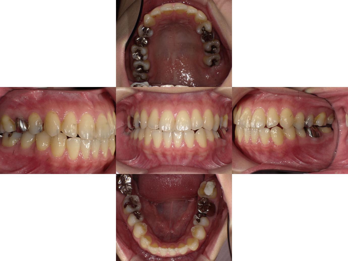 治療前 虫歯治療後に入れた銀歯をセラミッククラウンに交換した症例