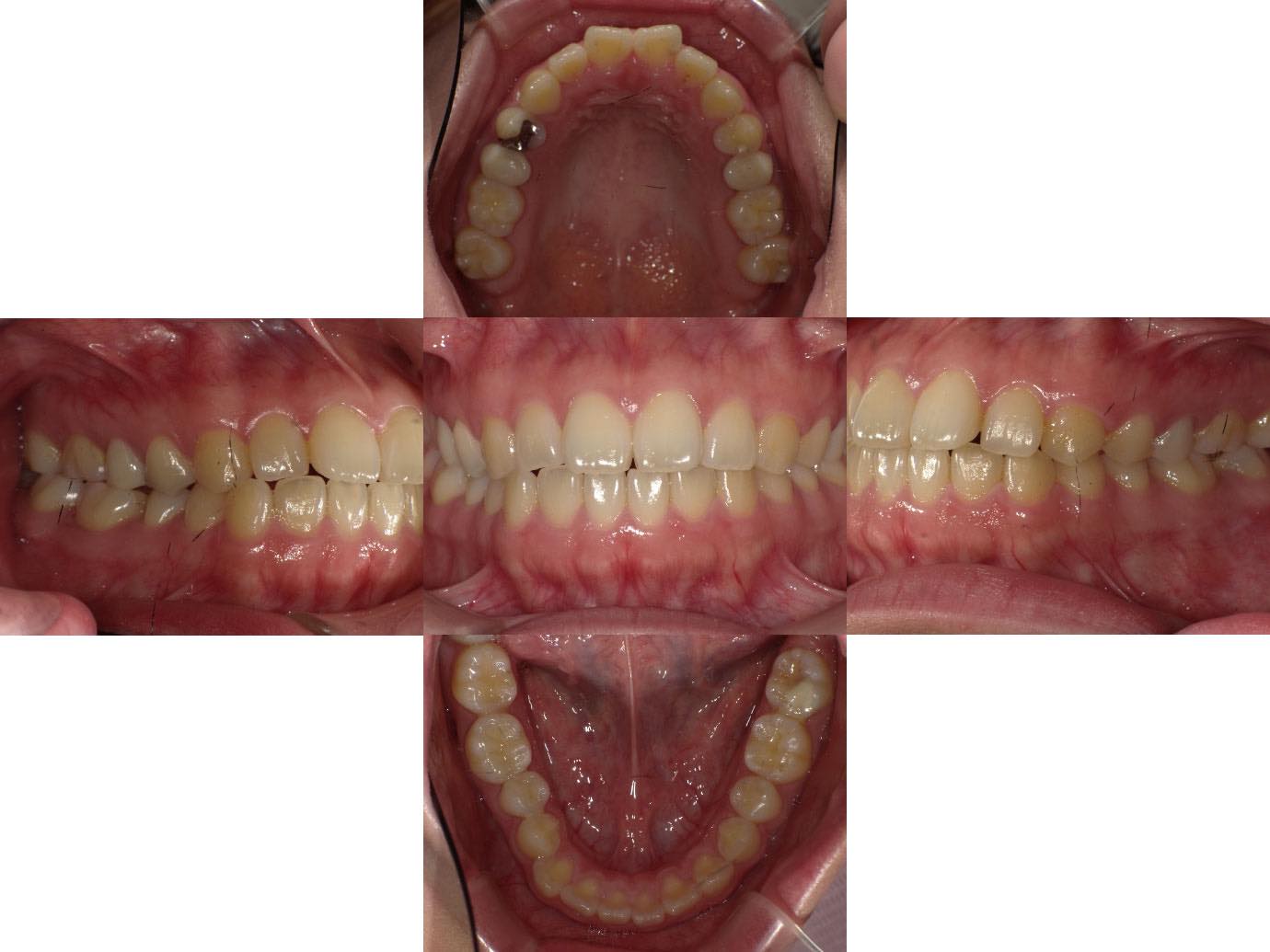 治療後 部分銀歯と全体銀歯をセラミックインレーとセラミッククラウンに交換した症例1