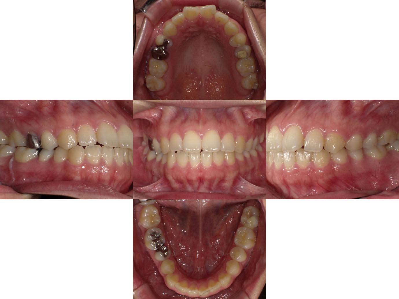 治療前 部分銀歯と全体銀歯をセラミックインレーとセラミッククラウンに交換した症例1