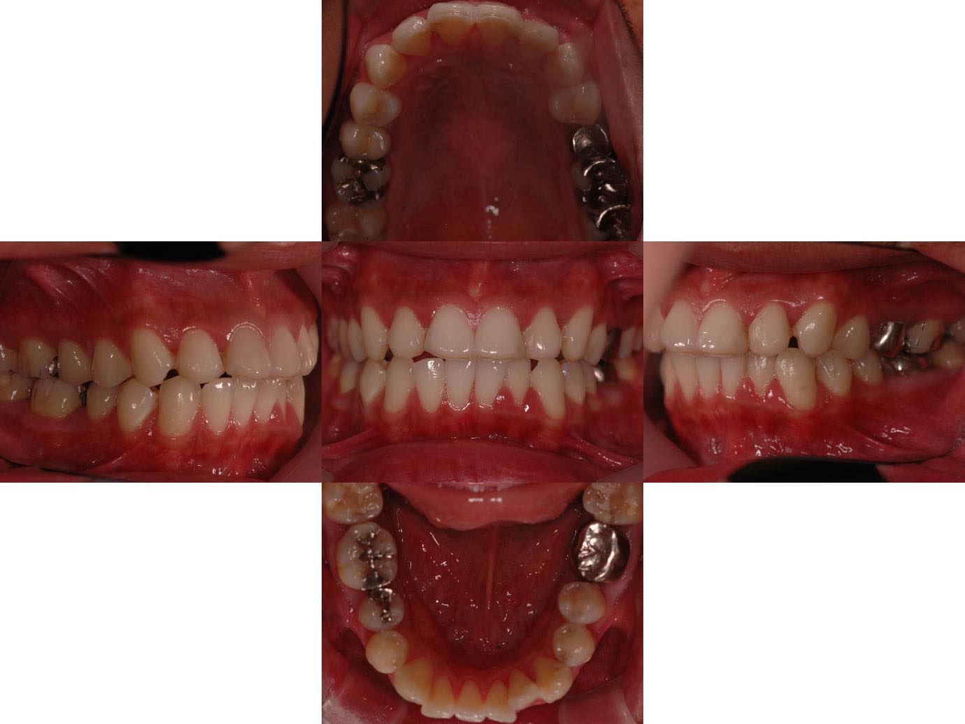 治療前 部分銀歯と全体銀歯をセラミックインレーとセラミッククラウンに交換した症例2