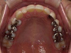 銀歯の症例　メタルフリー修復