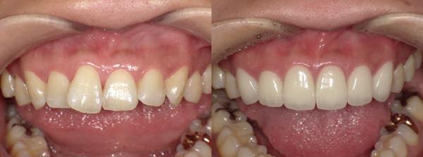 セラミック矯正による前歯の部分矯正の症例