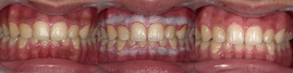 ガムピーリングによる歯茎の黒ずみの改善の症例