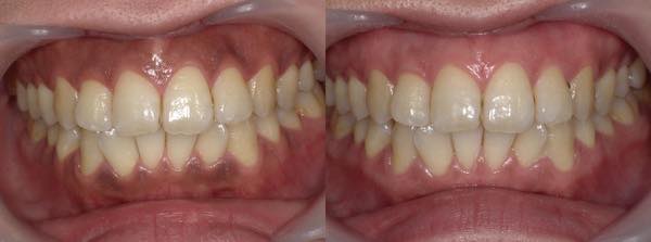ガムピーリングによる歯茎の黒ずみ改善の症例2