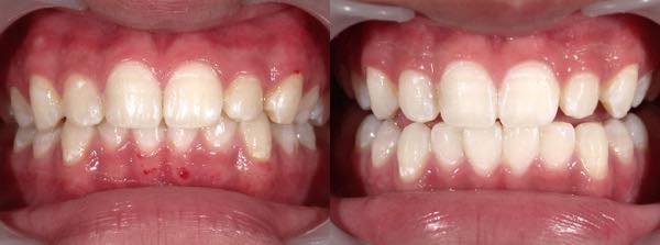 歯のホワイトニングの症例