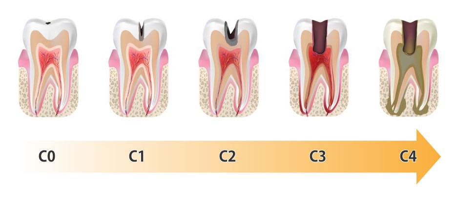 カリソルブ 虫歯の進行度合い