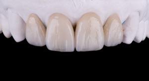 受け口の原因が歯にあり、セラミック矯正を適用するケース