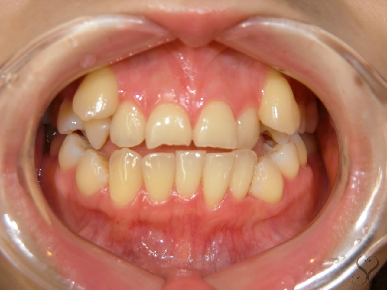 八重歯で乱杭歯！この歯並びはセラミック矯正で治療できる？