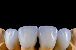 八重歯、乱杭歯の歯並びはセラミック矯正で治療が可能