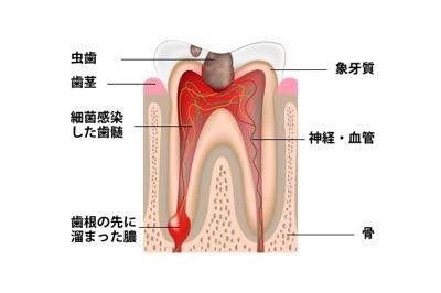 根管治療が必要な歯の状態 根管治療