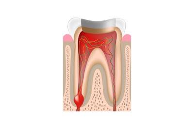 虫歯の除去 根管治療