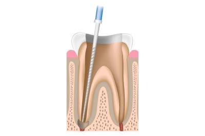 虫歯に感染した歯髄の除去 根管治療