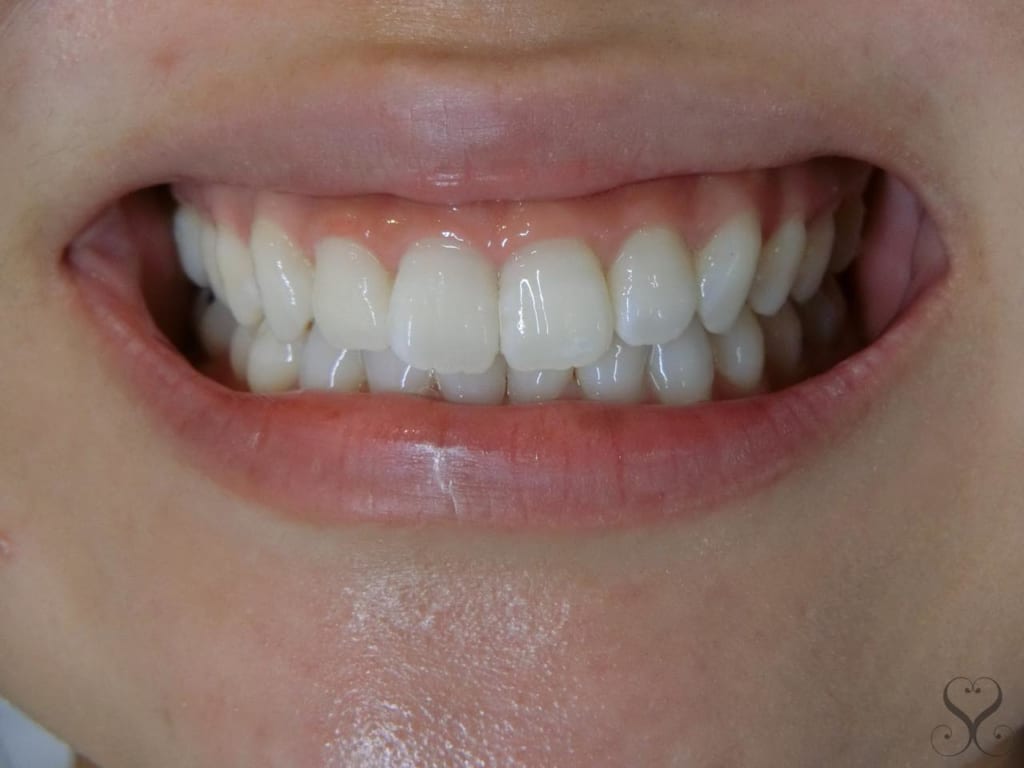 歯茎を切除する歯肉整形のデメリットは 後戻りで失敗しないための予備知識 南青山矯正歯科 審美歯科