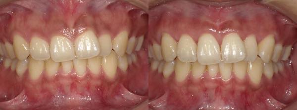 歯肉整形 | 南青山矯正歯科・審美歯科