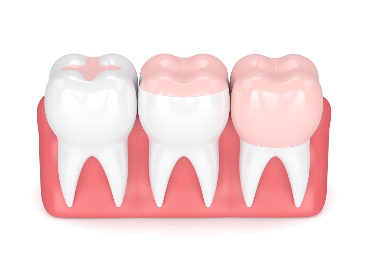 インレーとクラウンの違いとそれぞれの素材と適応について - 南青山矯正歯科・審美歯科