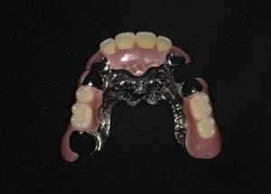 エステティックデンチャー 金属床義歯