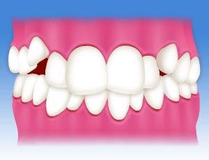 八重歯 前歯の矯正