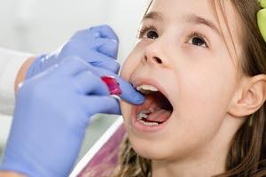 Ⅱ期治療（永久歯列期の治療）開始 小児矯正