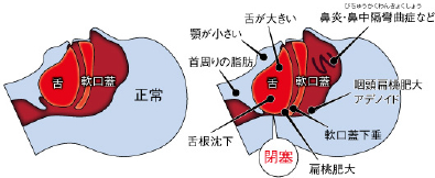 レーザー 治療 いびき
