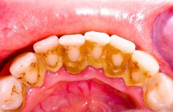 歯垢・歯石の症例