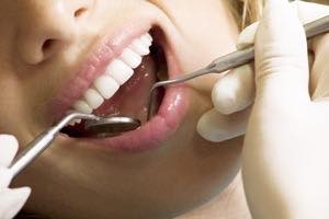 虫歯チェック PMTC（歯のクリーニング）