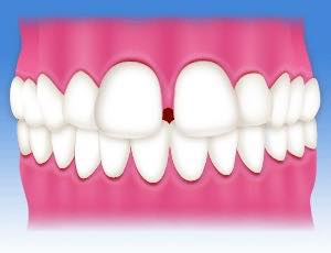 空隙歯列（すきっ歯） 歯列矯正
