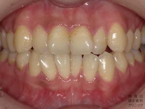 変色した歯の症状