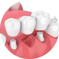 歯のブリッジ 審美歯科治療