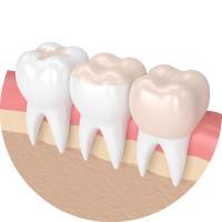 セラミック治療 歯の黄ばみ