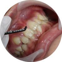 歯肉整形 審美歯科治療