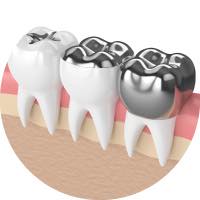 銀歯の交換 セラミック治療