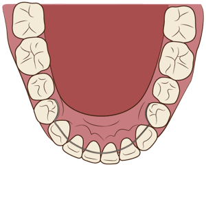 歯並びが整った状態 ワイヤー矯正