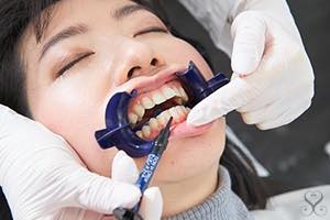歯茎の保護 オフィスホワイトニング