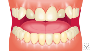 歯列不正・歯牙の着色　セラミック矯正