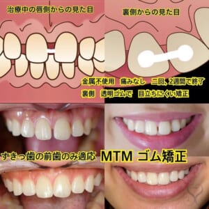 モニター　MTM矯正 / 1歯