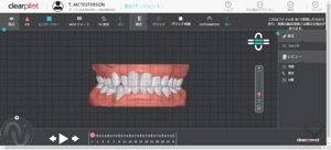 治療計画3D set-up シミュレーションツール「ClearPilot」
