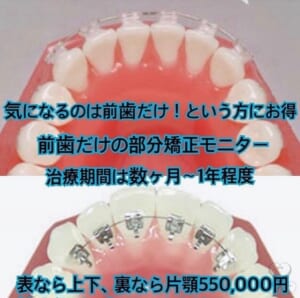 モニター 前歯の部分矯正