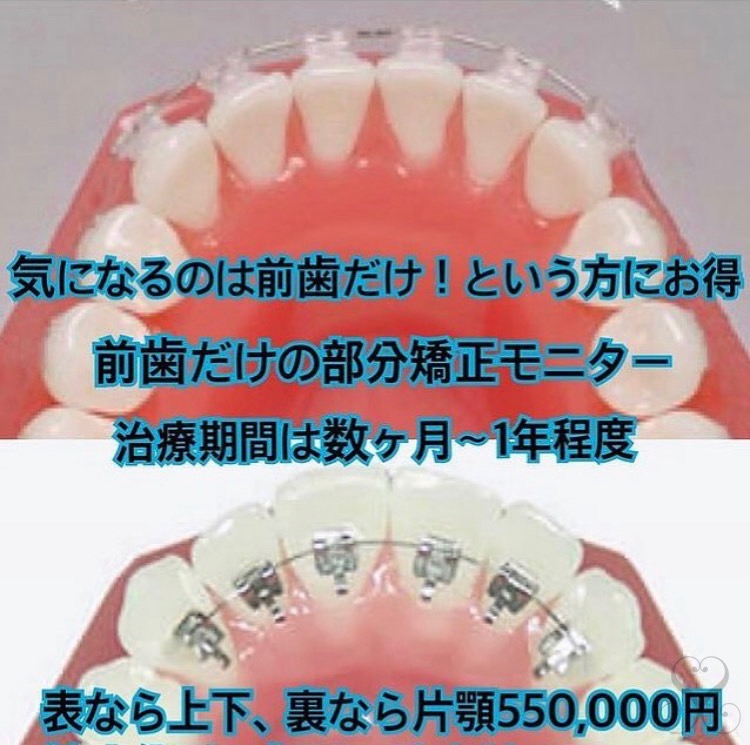 モニター　前歯の部分矯正