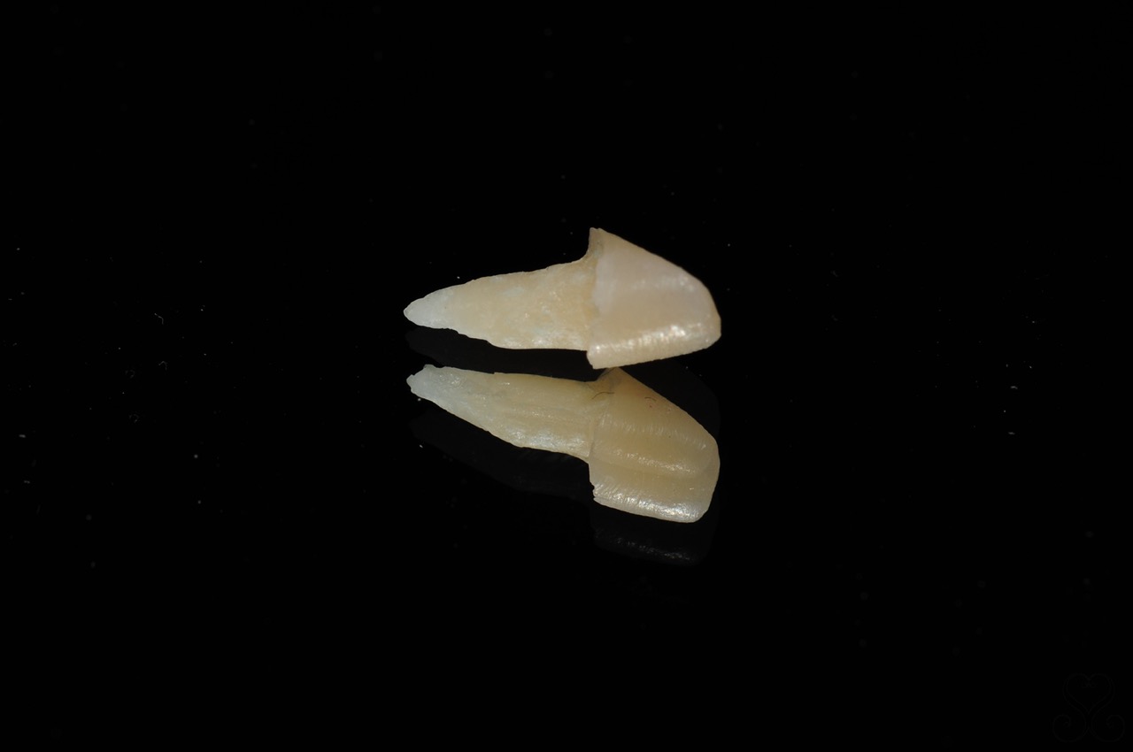 歯の土台(コア)の種類と材質選びの重要性