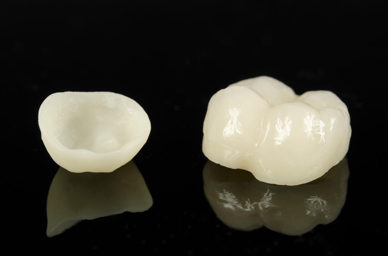 歯のセラミックの種類は？材質ごとの違いを徹底比較