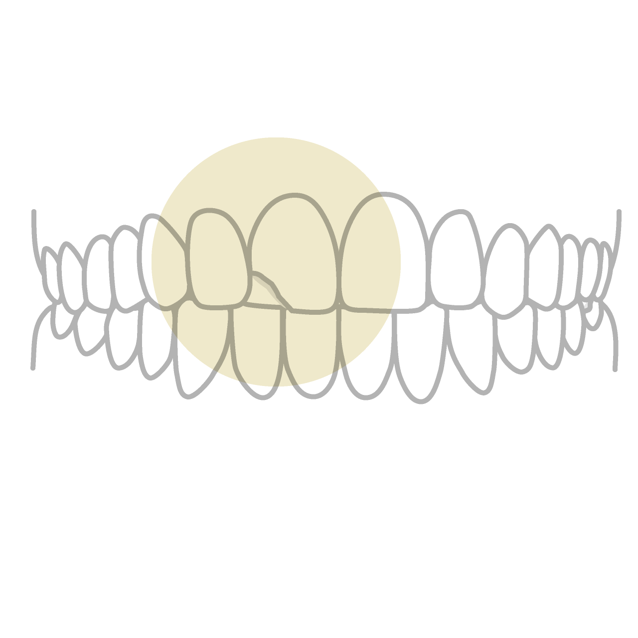 歯の欠け