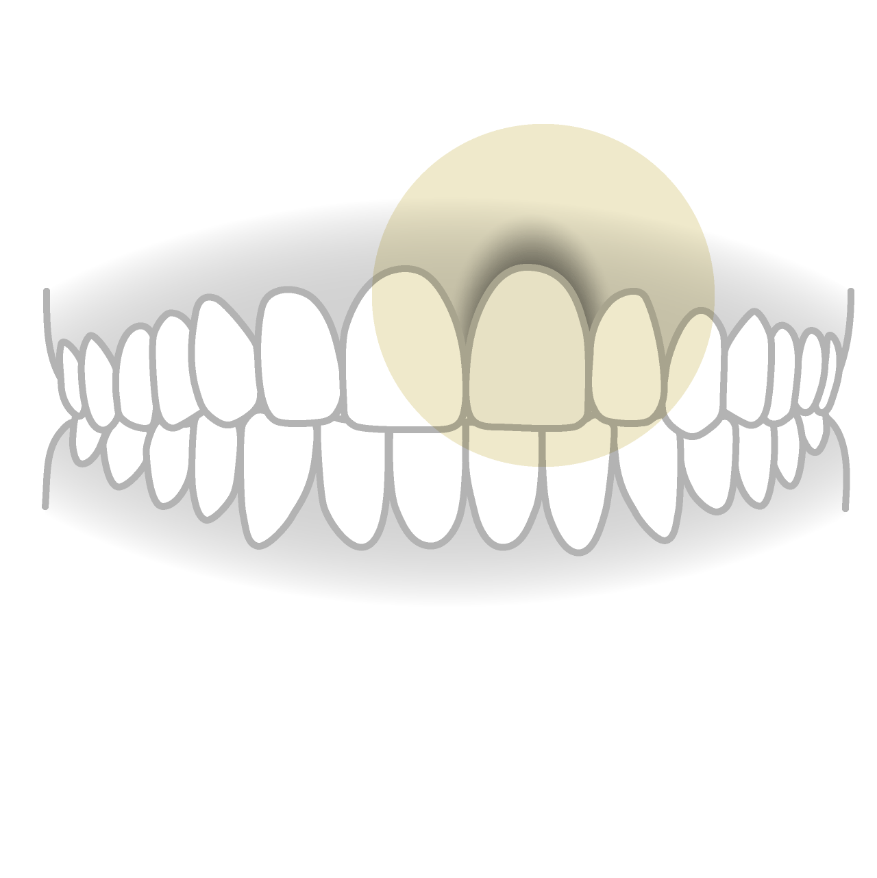 歯茎の黒ずみ（メタルタトゥー）