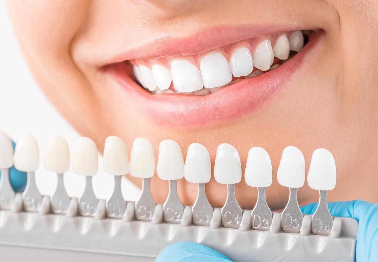 ホワイトニングは歯に悪い？歯の健康への影響の可能性を解説