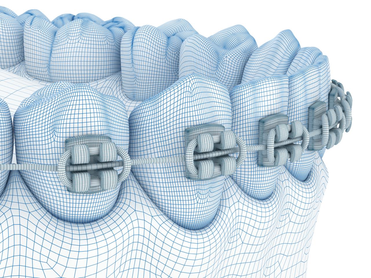 歯を早く移動させるコルチコトミーを併用した歯列矯正